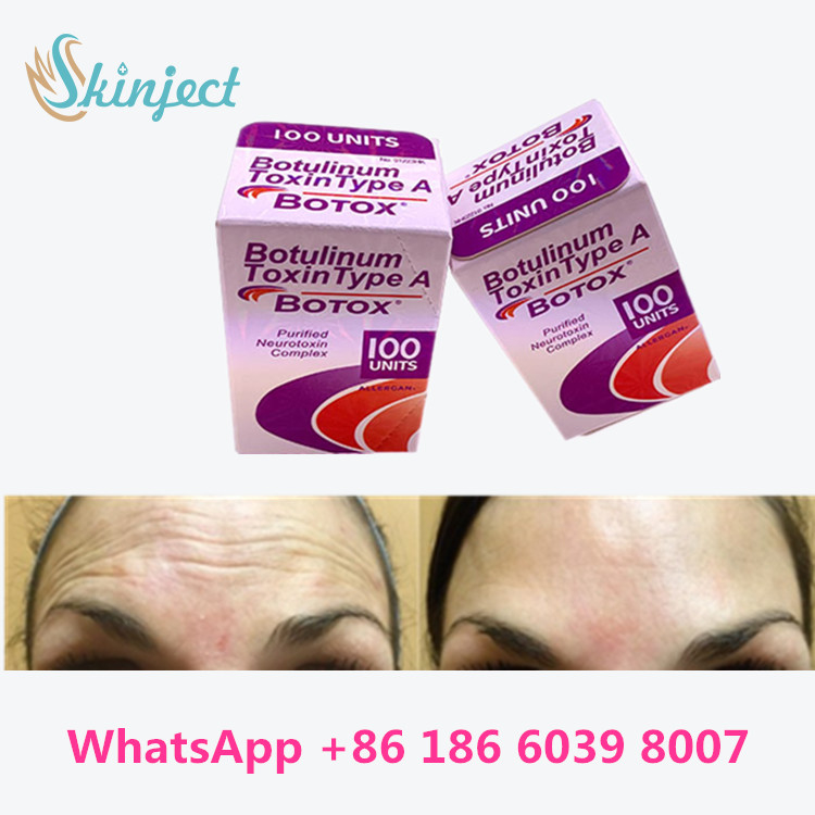 allergan botulinum toxine Anti het Verouderen Productentype A Toxine Antirimpel