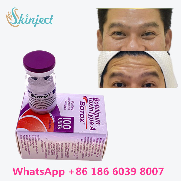 100 Eenheden Type A Botulinum Toxine 2 - 8°C-Opslagtemperatuur