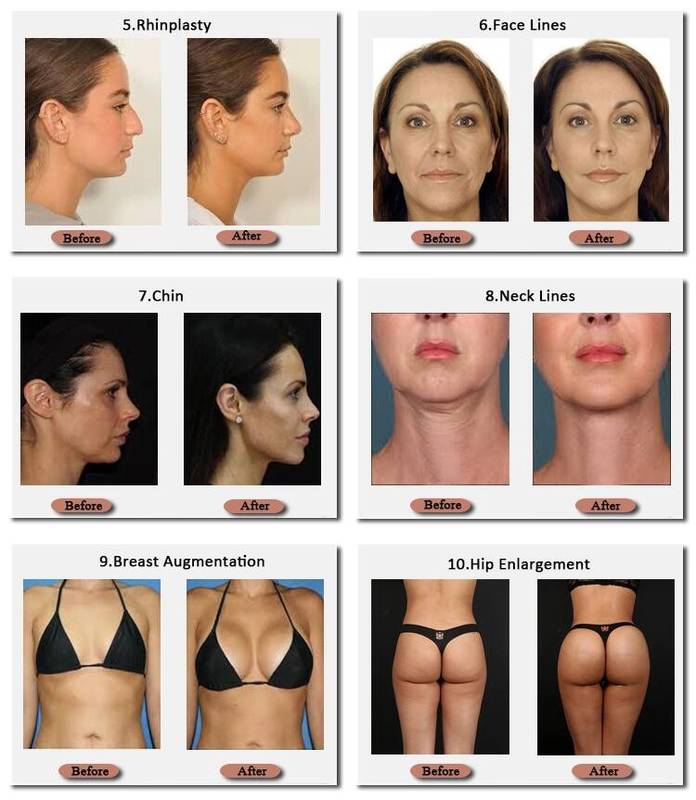 Skinjection Hyaluronic de Borstvuller Koreaanse Technnology van 10 Ml en van 20 Ml 24 Mg/ml