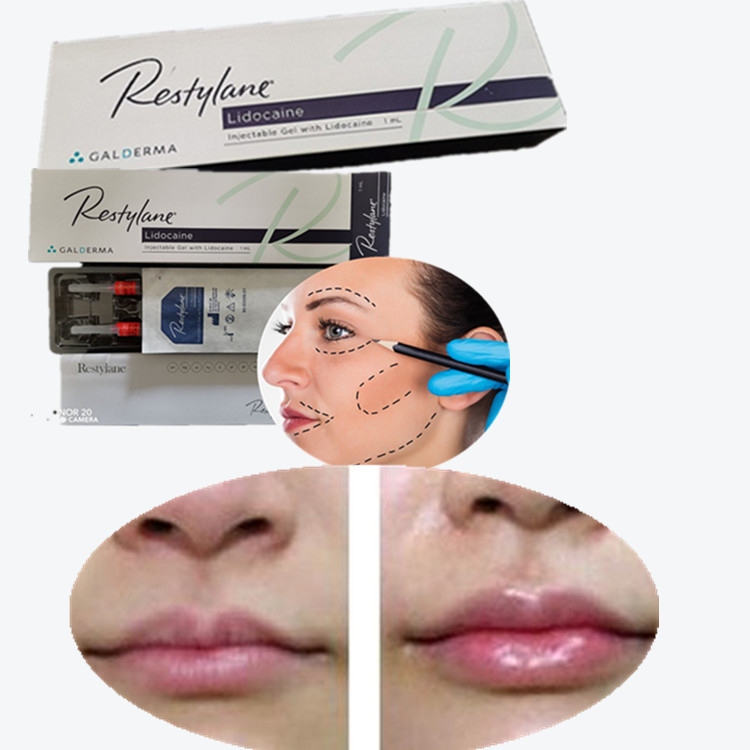 Dermale vulmiddel Lip Injecties Koreaanse originele authentieke producten Lip Natrium Hyaluronate Filler
