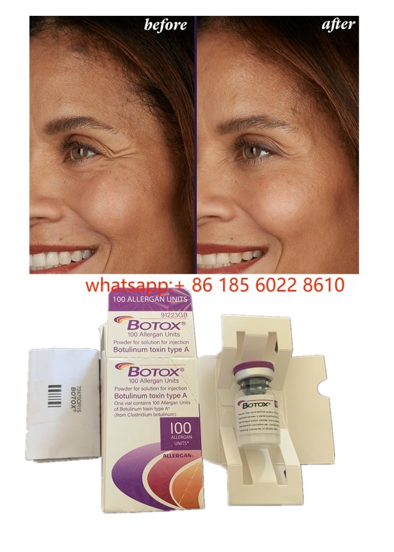 Schoonheidsproducten Allergan 100 eenheden Botulinum Toxin  voor gezichtsrimpels Huidvuller