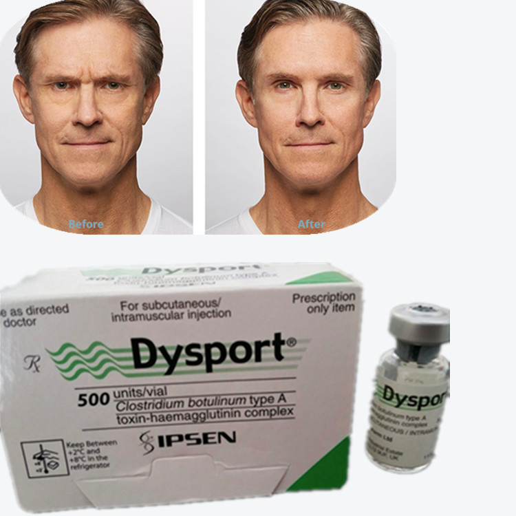 Botulinum Toxin Dysport 100 IE Botulinum Toxin type A voor rimpelverwijdering