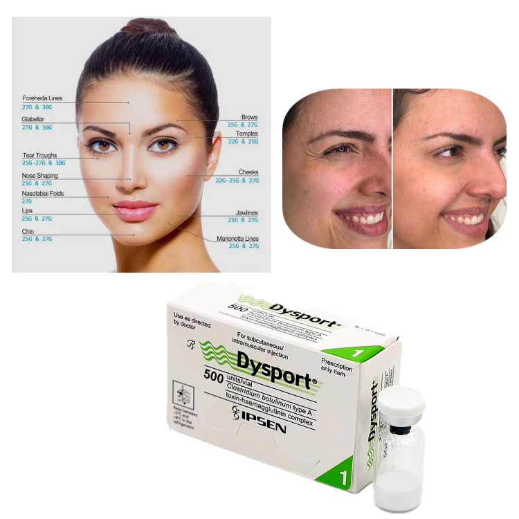 Dysport 500U Botulinum Toxin Type A voor de behandeling van rimpels