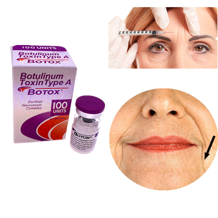 Allergan Botox 100IU Botulinum Toxin Type A Voor het verwijderen van rimpels in gezicht en ogen