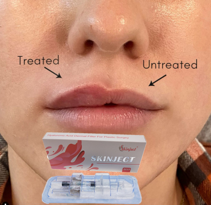 De injecteerbare Diepe Hyaluronic Zure Huid2ml-Wang Chin Nasolabial Fold van de Lippenvuller