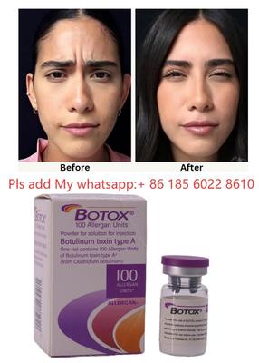 ALLERGAN Botox Injectie Botulinetoxine Type A